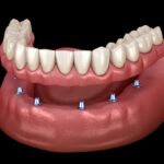 implant-supported dentures, types of implant-supported dentures, dental implants, fixed dentures, All-on-4® implants, Riverstone Dental Care, dentist in Canton, GA, implant dentures Canton GA