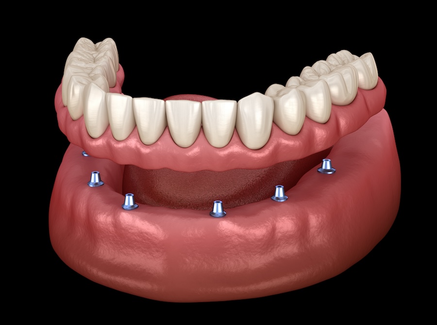 implant-supported dentures, types of implant-supported dentures, dental implants, fixed dentures, All-on-4® implants, Riverstone Dental Care, dentist in Canton, GA, implant dentures Canton GA