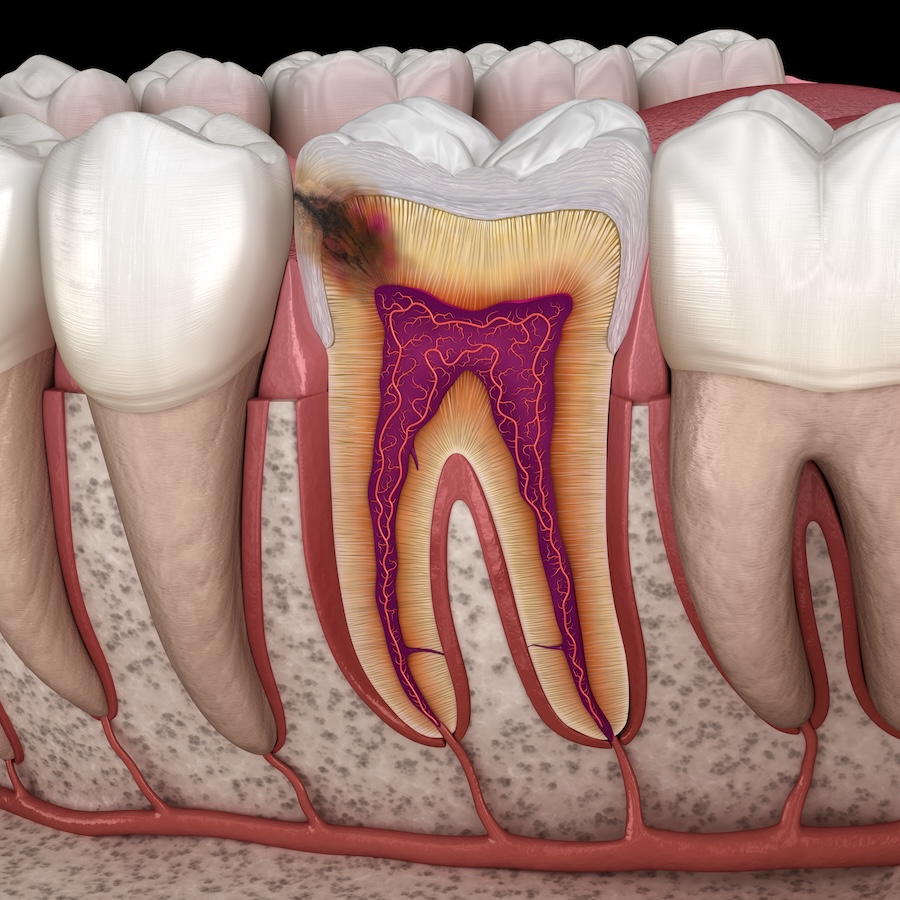 Hidden caries in to molar tooth. Medically accurate 3D illustration, early signs of tooth decay